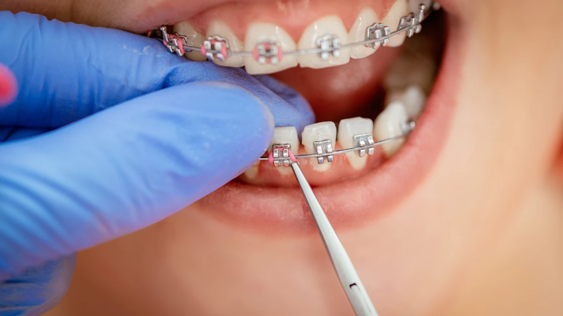 Orthodontic Emergencies: What to Know and What to Do