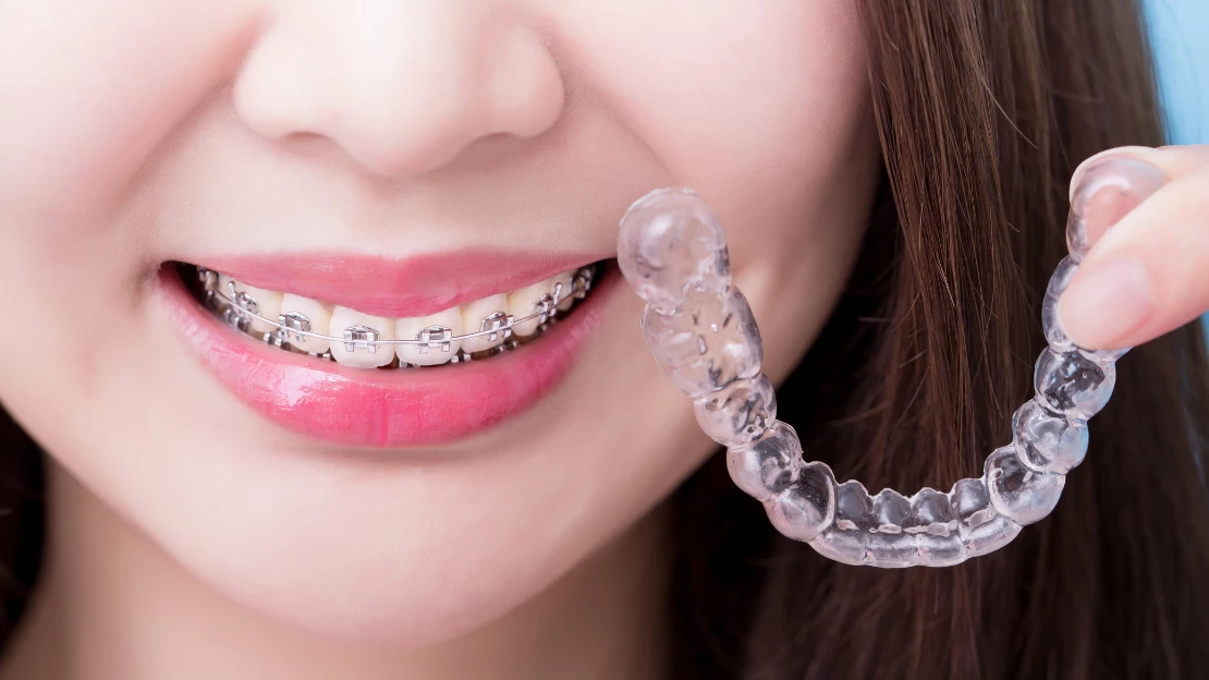 Invisalign vs. Traditional Braces: Which is the Best For You? - Sharp  Orthodontics